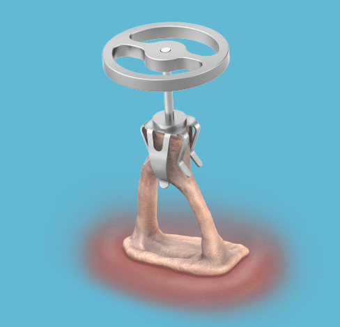 Grace Medical NyteByte Partial