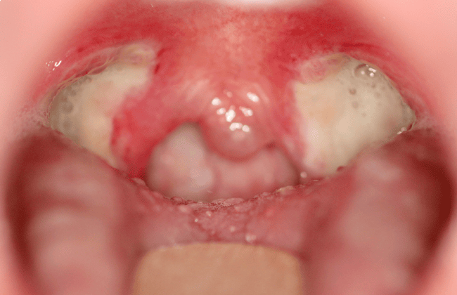 Sealk-on-Tonsil-Bed